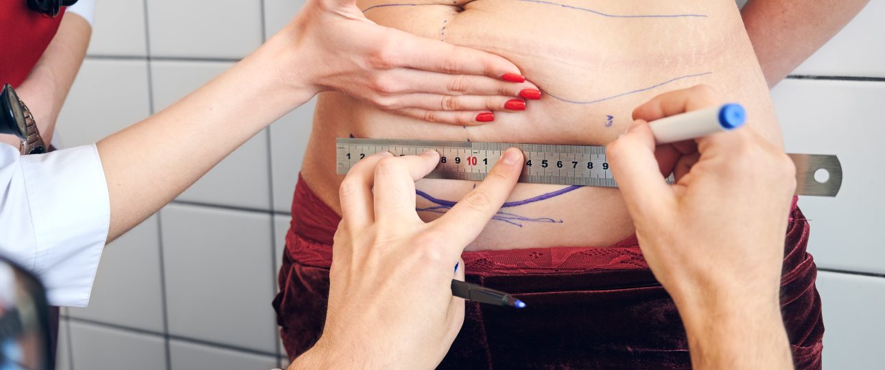 Liposuction Prices in Turkey