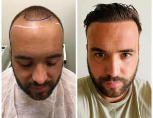 Frontal Hairline Transformation