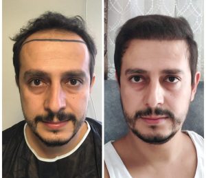 DHI Natural Look Transformation
