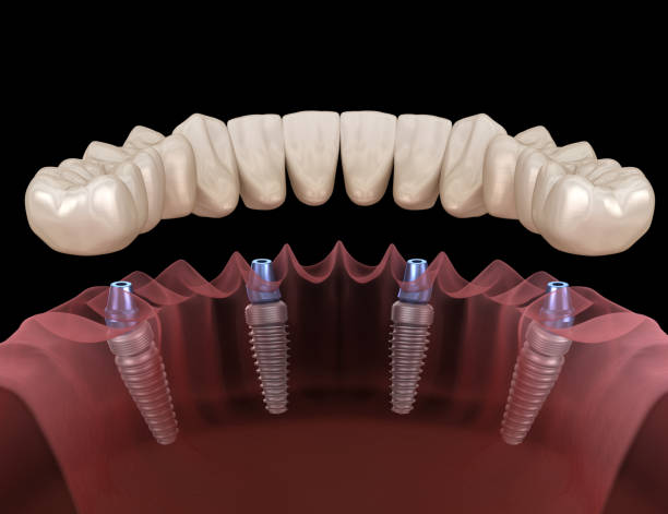 Dental Implant Cost in Turkey 