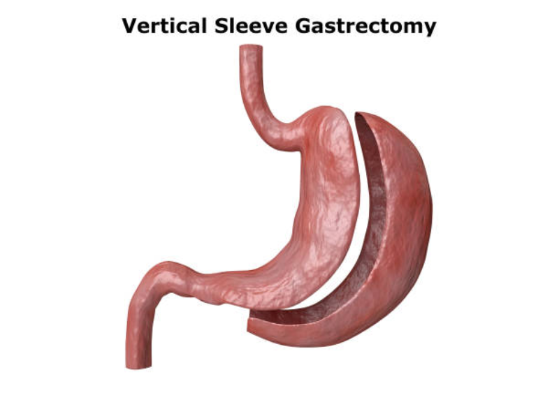 Gastric Balloon or Gastric Sleeve