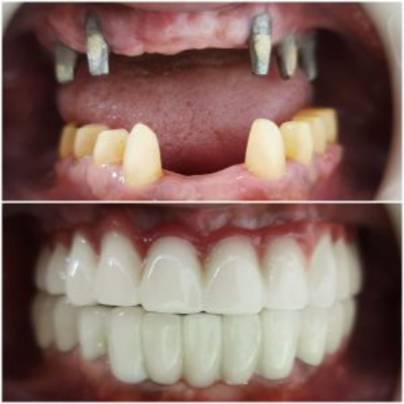 Dental Implant in Turkey 
