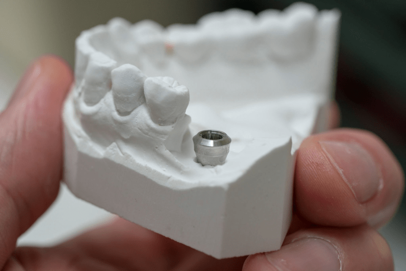 Dental Implant in Turkey 