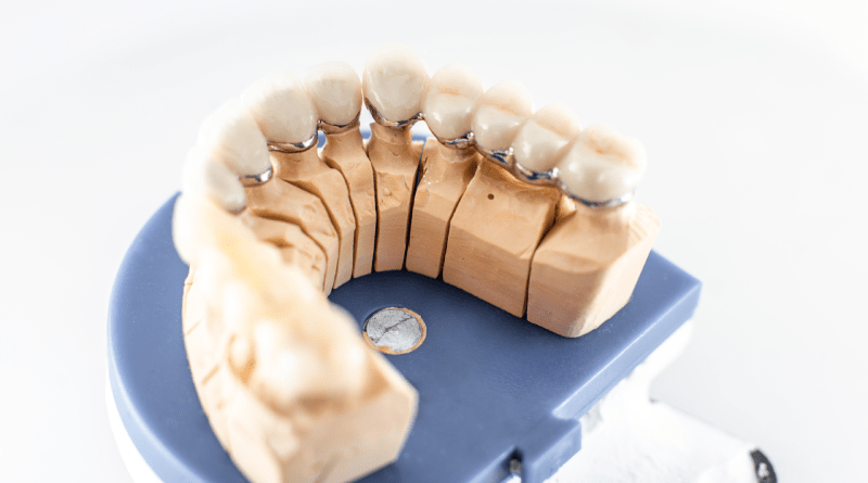 Alanya Dental Implant