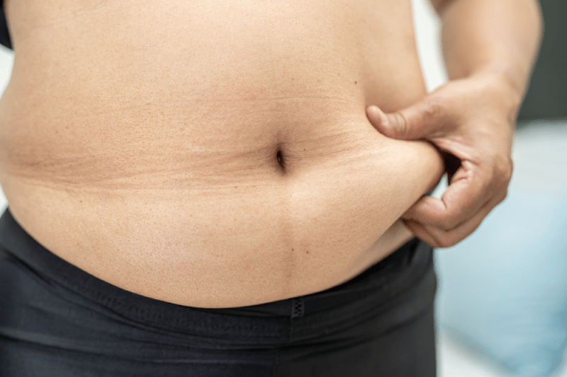 Stomach Reduction Surgery