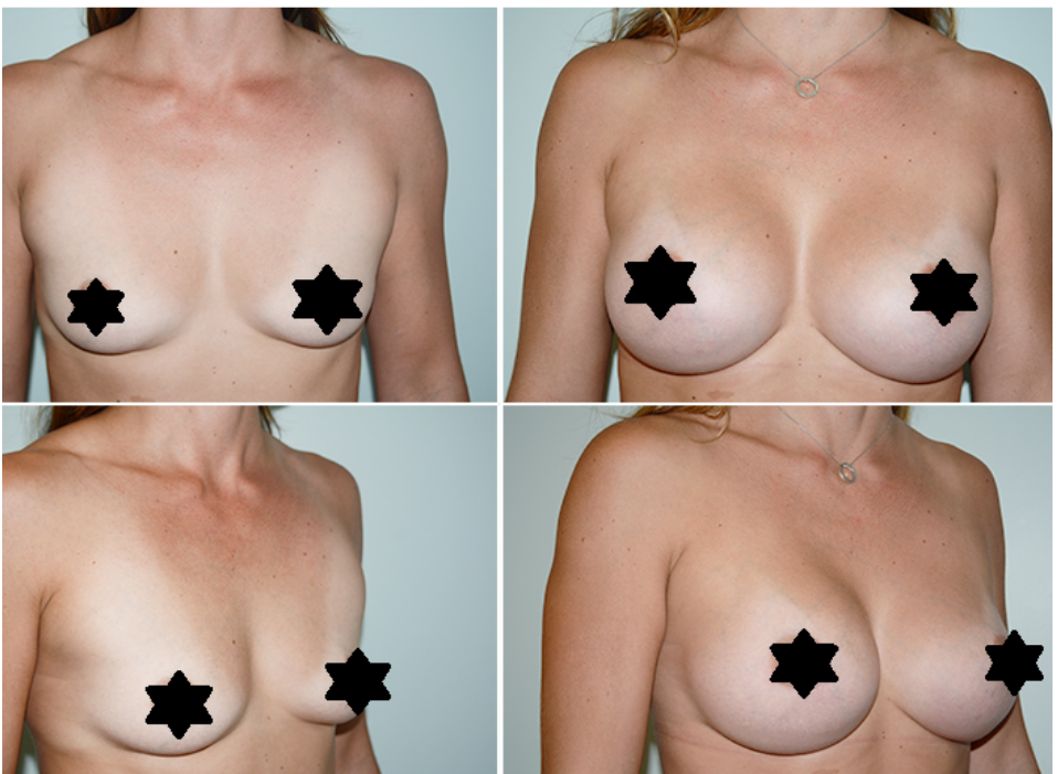 breast augmentation 