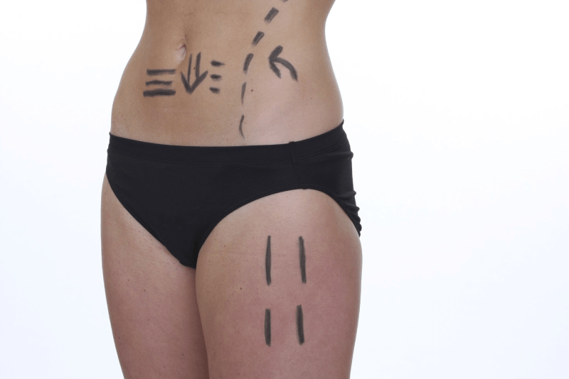 Liposuction Cost in the UK