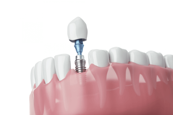 Cheapest and Safest For Dental Implants