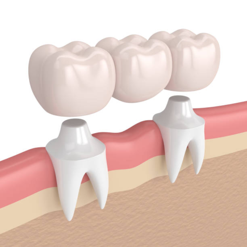 Dental Bridge Treatment Alternatives in Turkey
