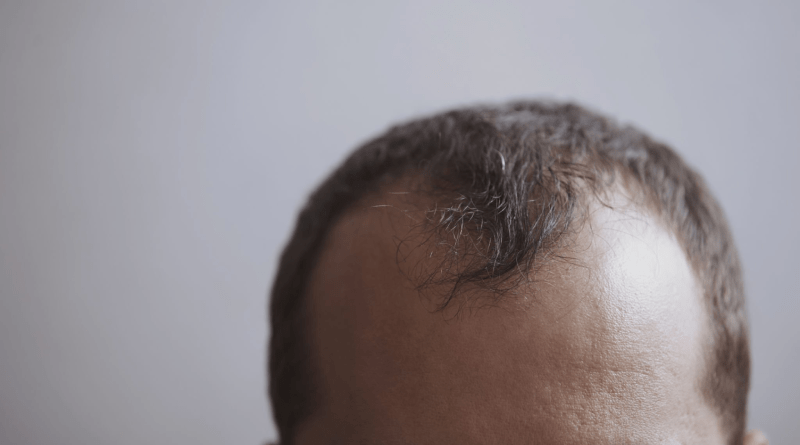 Hair Transplant Centres in Istanbul