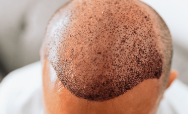 Hair transplant in turkey