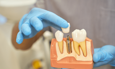Full Mouth Dental Implants Cost Izmir